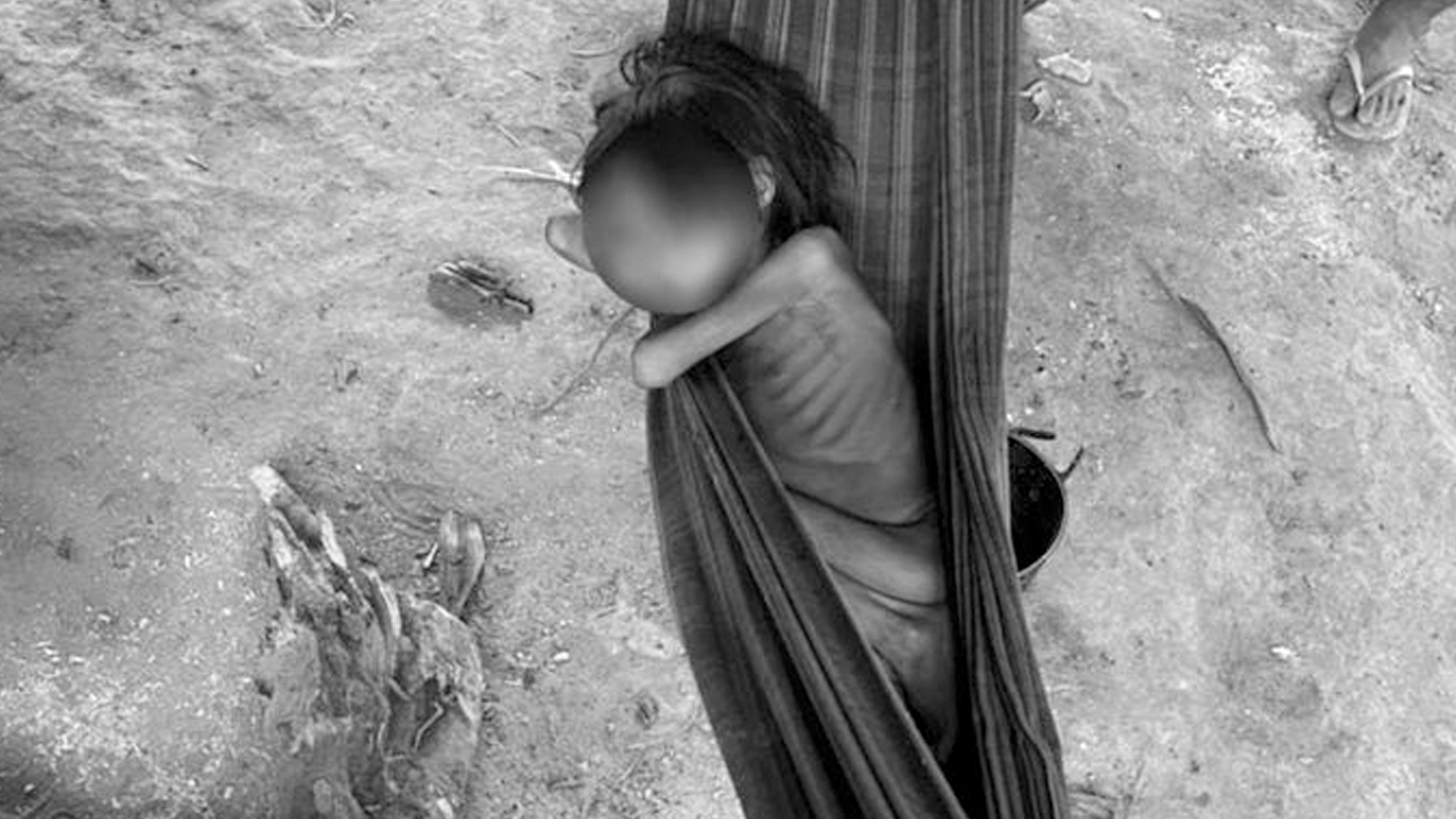 Desnutrição Extrema: O Rosto da Crise Humanitária