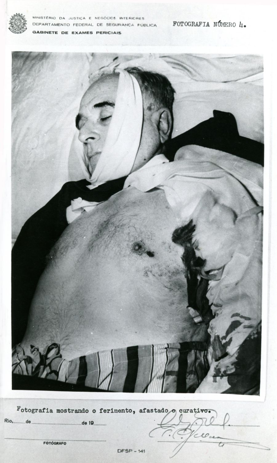 Autópsia de Getúlio Vargas: Ferimento de bala exposto